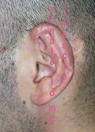 Chirurgia dell'Orecchio | Lesioni Auricolari acquisite - dopo l'intervento