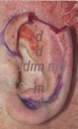 Chirurgia dell'Orecchio | Lesioni Auricolari acquisite - dopo l'intervento