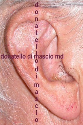 Chirurgia dell'Orecchio | Lesioni Auricolari acquisite - dopo l'intervento