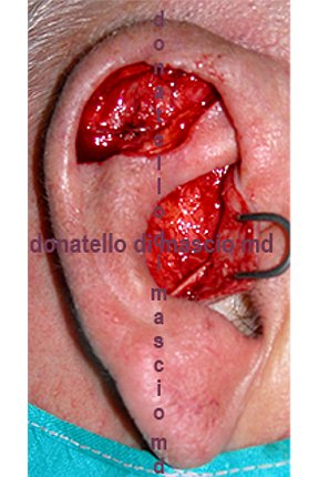 Chirurgia dell'Orecchio | Lesioni Auricolari acquisite - dopo l'intervento