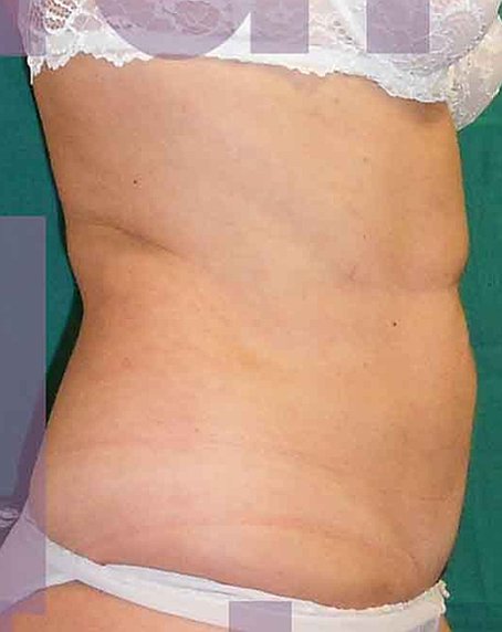 Chirurgia Estetica Addome | Liposcultura Addome - dopo l'intervento