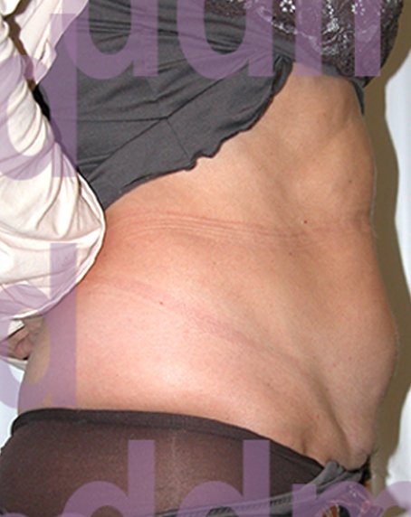 Chirurgia Estetica Addome | Liposcultura Addome - prima dell'intervento